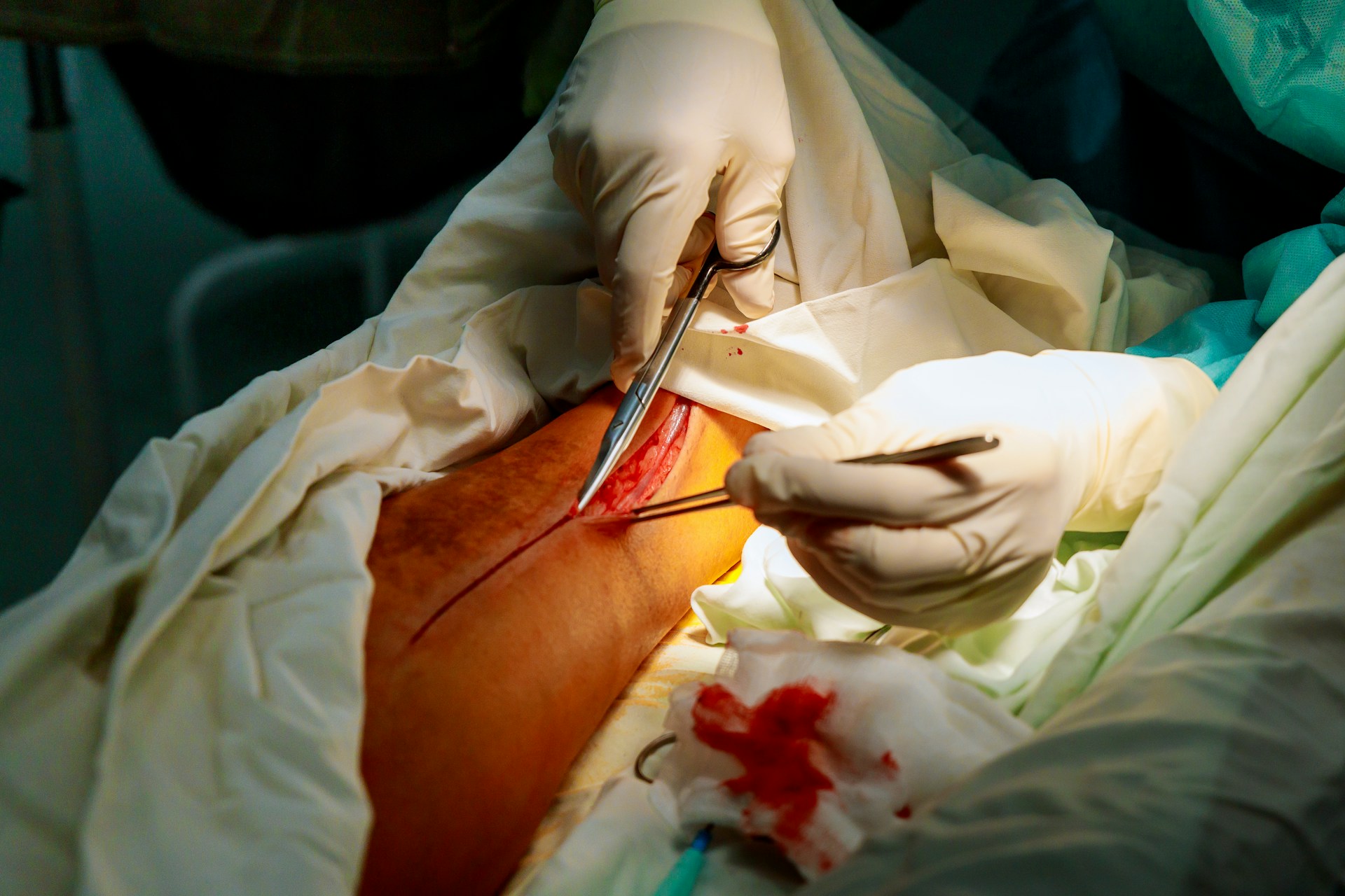 Minimally Invasive Aortic Surgery